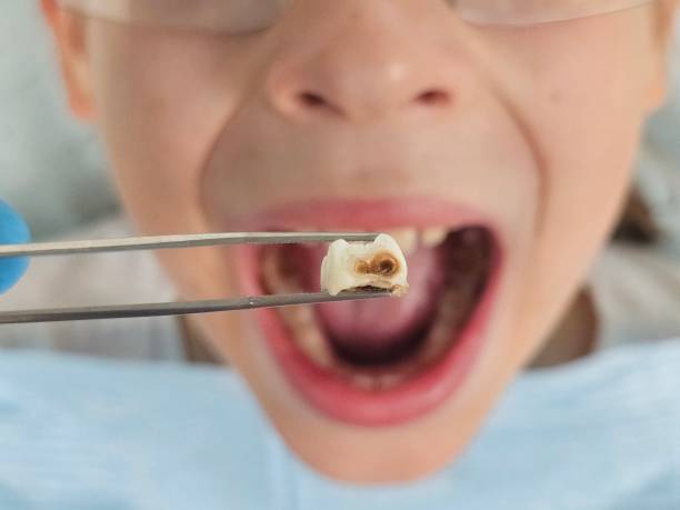 Best Emergency Treatment for Toothache in North Grosvenor Dale, CT