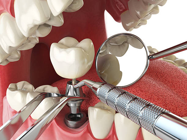 Best Emergency Wisdom Teeth Removal in North Grosvenor Dale, CT